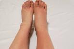 Mengatasi Jari Kaki Bengkak Penyebab, Gejala, dan Tips Kesehatan